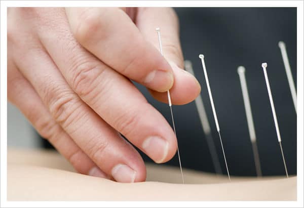Agujas de acupuntura